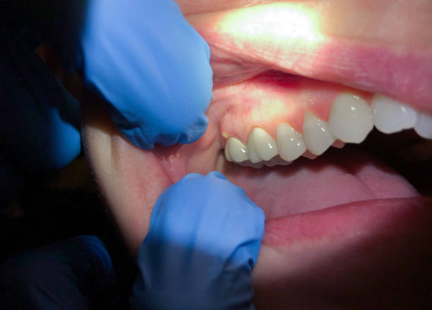 Best Lost Filling or Crown Replacement in Oildale, CA